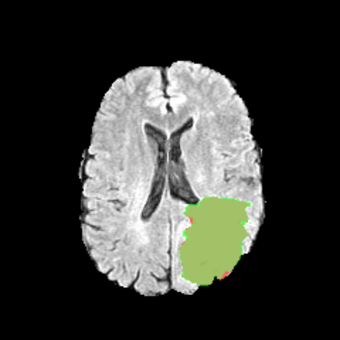 Brain MRI with tumour segmentation overlay