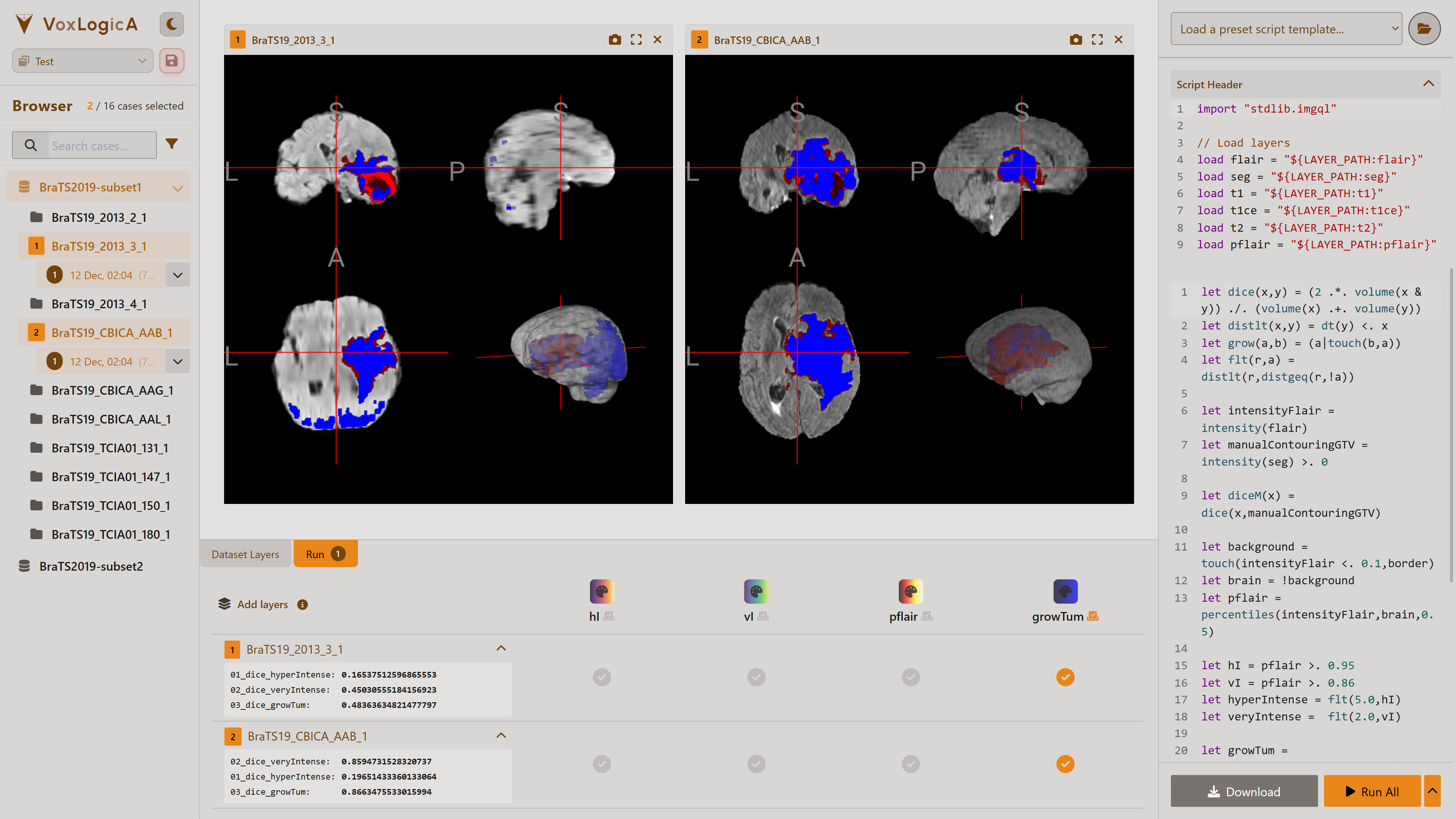 VoxLogicA UI — multi-view MRI visualization with ImgQL editor